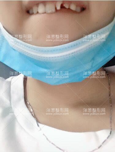 鄧悅醫(yī)生牙齒修復(fù)案例