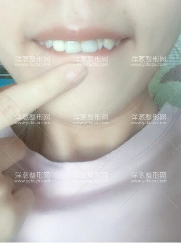 鄧悅醫(yī)生牙齒修復(fù)案例