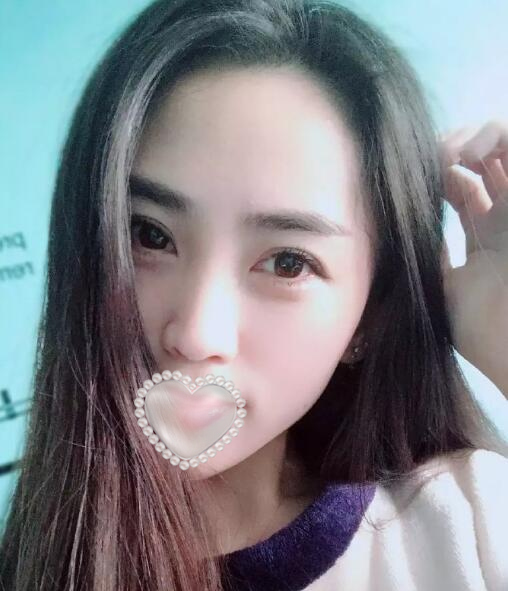 于海生醫(yī)生面部脂肪填充案例