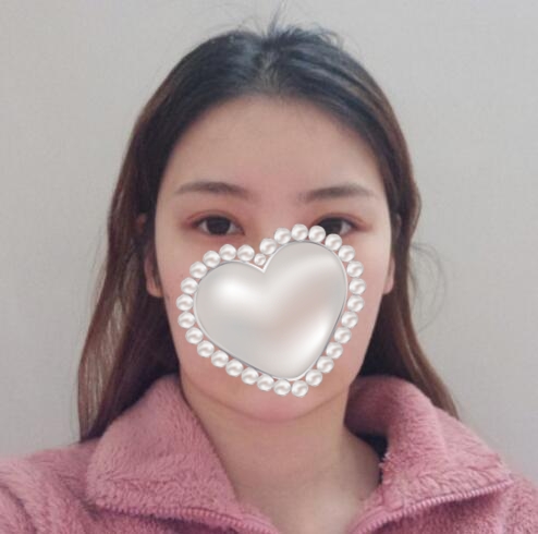 崔榮達(dá)做下頜角好嗎？案例分享