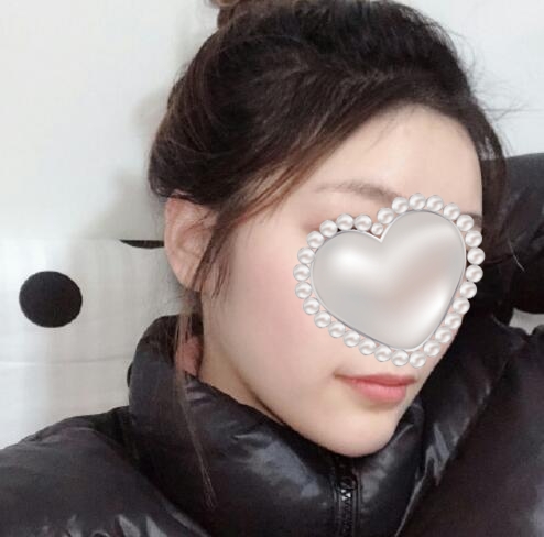 崔榮達(dá)做下頜角好嗎？案例分享