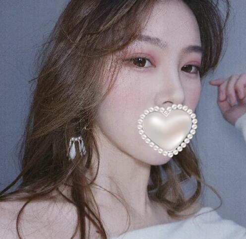 崔榮達(dá)做下頜角好嗎？案例分享