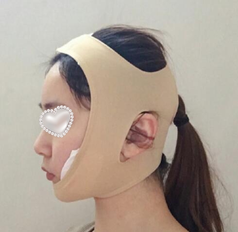 崔榮達(dá)做下頜角好嗎？案例分享