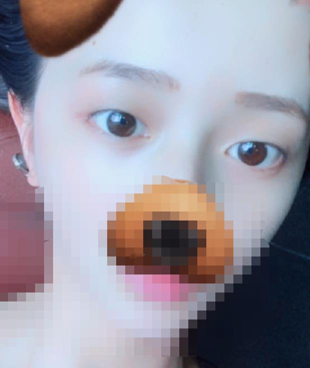 北京八大處趙延勇醫(yī)生做雙眼皮怎么樣？