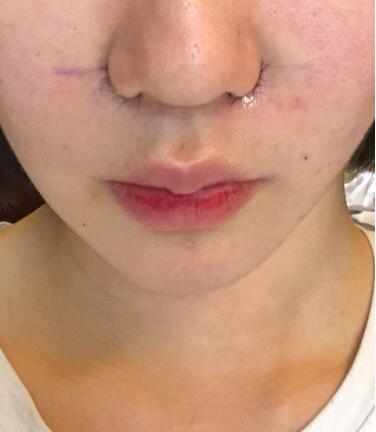 鼻頭鼻翼鼻尖整形過程日記分享