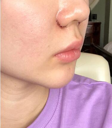 鼻頭鼻翼鼻尖整形過程日記分享