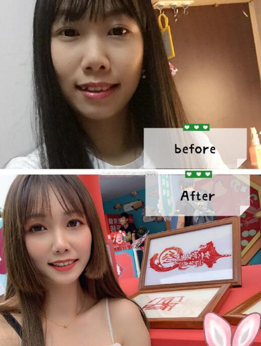 四川華西醫(yī)院口腔外科牙齒矯正案例分享