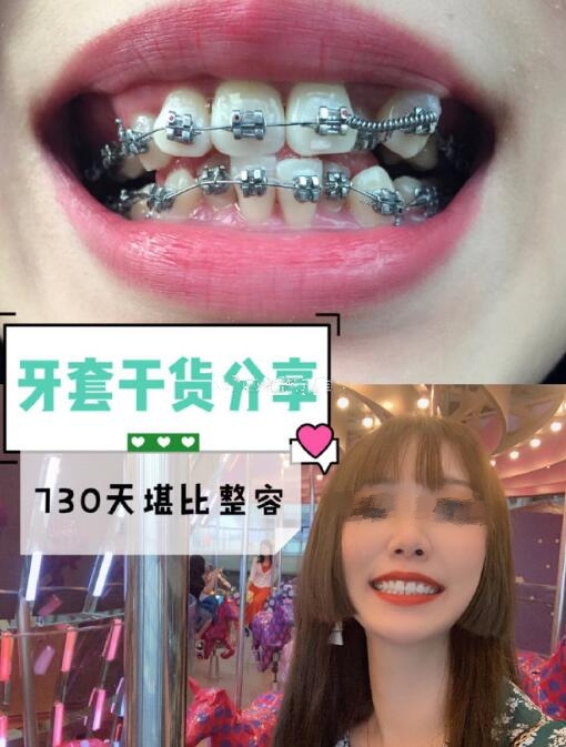 四川華西醫(yī)院口腔外科牙齒矯正案例分享