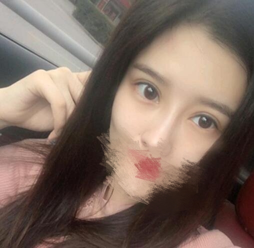 蔣小花醫(yī)生雙眼皮修復案例