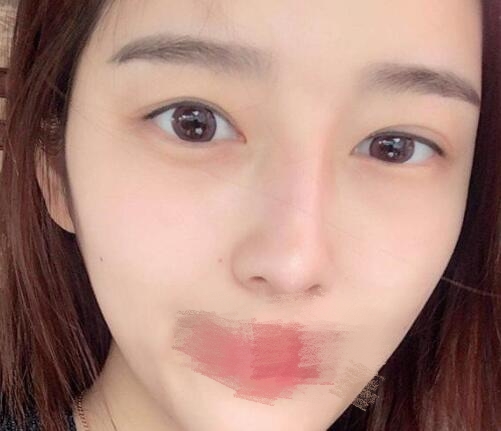 蔣小花醫(yī)生雙眼皮修復案例