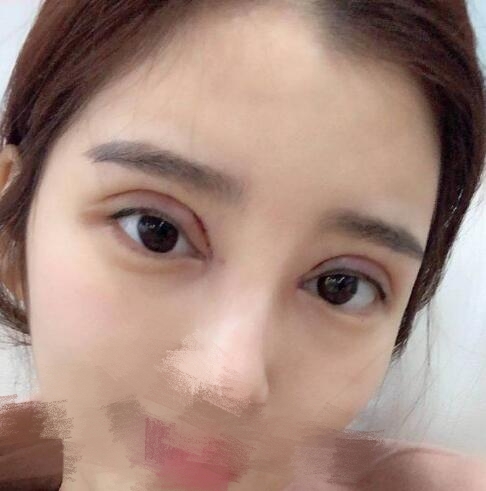 蔣小花醫(yī)生雙眼皮修復案例