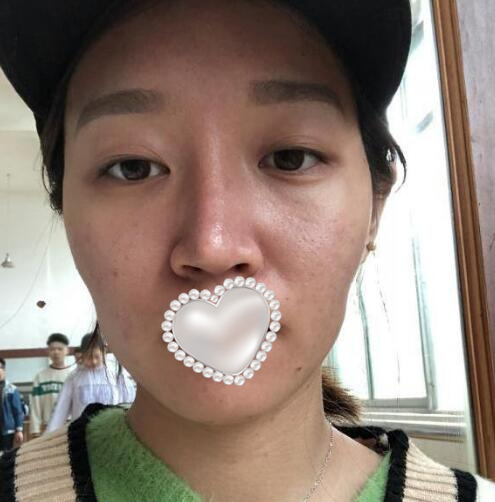 衡陽雅美姚江華醫(yī)生脂肪填充?案例