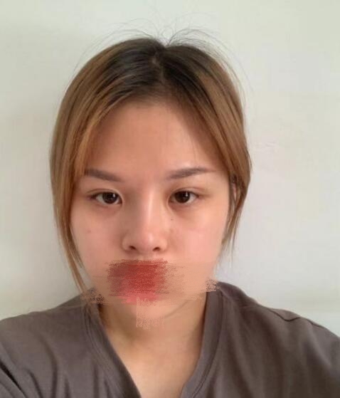 北京劉風(fēng)卓做雙眼皮修復(fù)案例