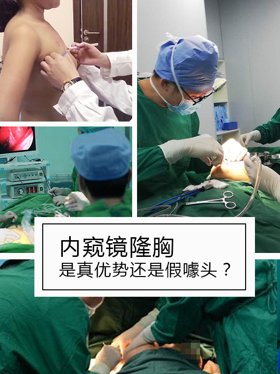 內(nèi)窺鏡德國vizaar威薩隆胸怎么樣