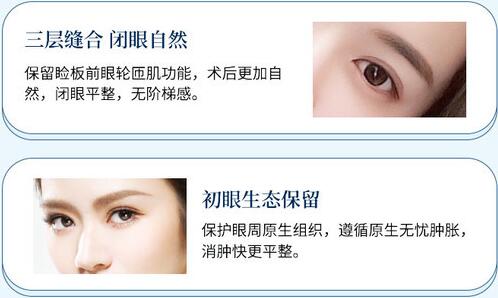 北京八大處盧建建醫(yī)生科普雙眼皮手術(shù)