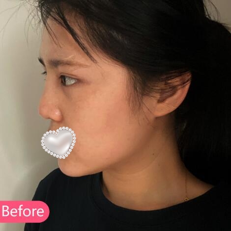 莊洪興醫(yī)生隆鼻果圖