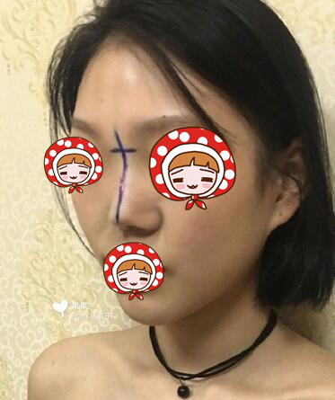 北京協(xié)和醫(yī)院整形外科黃渭清醫(yī)生隆鼻案例?