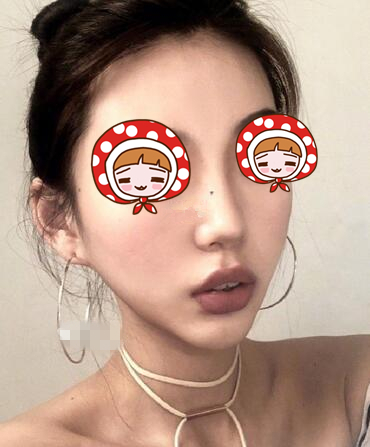 北京協(xié)和醫(yī)院整形外科黃渭清醫(yī)生隆鼻案例?