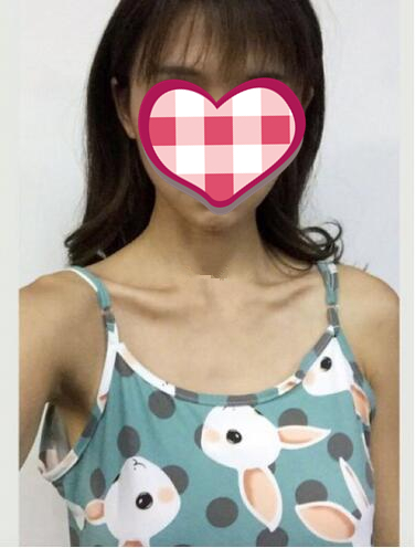 北京八大處隆胸李發(fā)成醫(yī)生案例分享