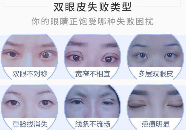 韓勛醫(yī)生介紹雙眼皮修復(fù)手術(shù)
