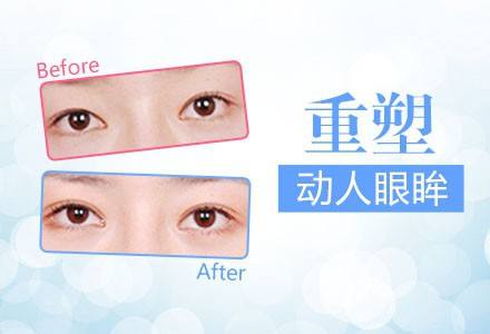 韓勛醫(yī)生介紹雙眼皮修復(fù)手術(shù)