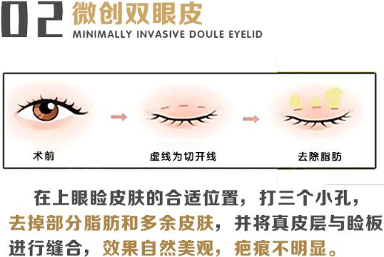 趙延勇醫(yī)生科普雙眼皮