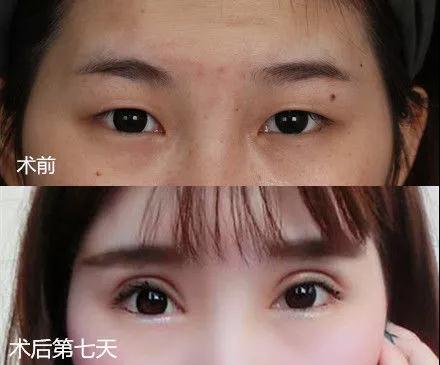 趙延勇醫(yī)生科普雙眼皮
