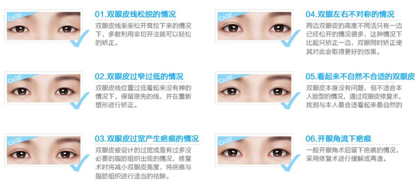 劉風(fēng)卓醫(yī)生科普雙眼皮修復(fù)手術(shù)