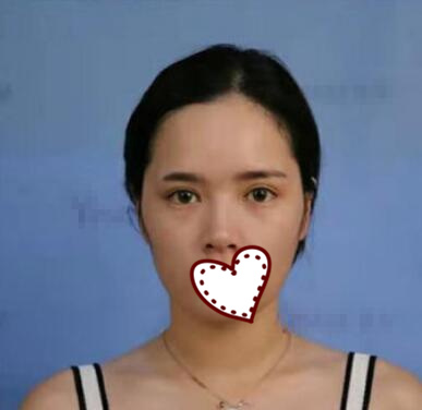 何禎平醫(yī)生隆鼻案例