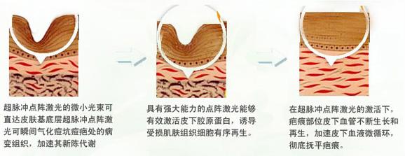 點(diǎn)陣激光去痘坑介紹