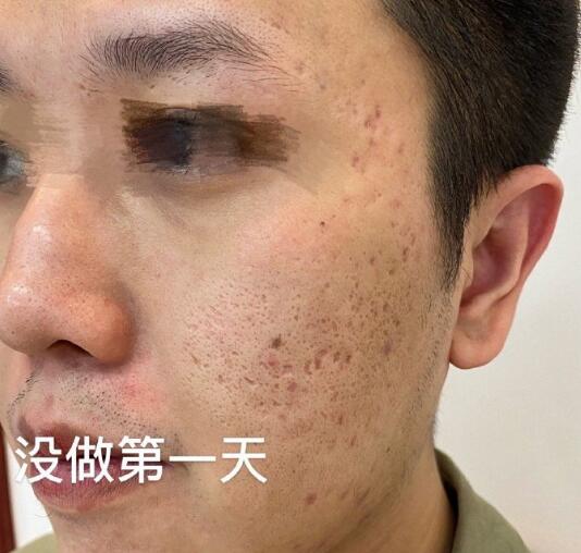 點(diǎn)陣激光如何去痘坑?