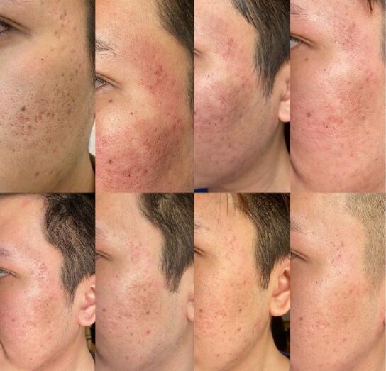 點(diǎn)陣激光如何去痘坑?