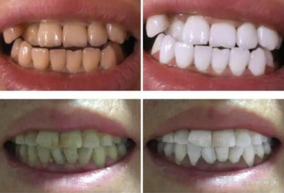 冷光美白牙齒的價(jià)格多少錢