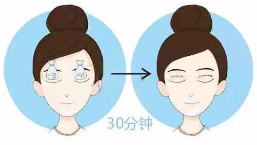 韓式三點(diǎn)式雙眼皮術(shù)后護(hù)理