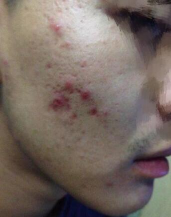 像素激光調(diào)節(jié)痘疤體驗(yàn)日記