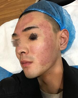 像素激光調(diào)節(jié)痘疤術(shù)后果圖