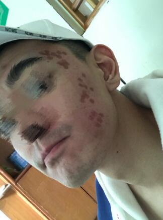 像素激光調(diào)節(jié)痘疤術(shù)后果圖