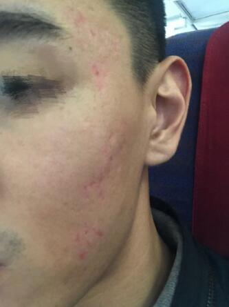 像素激光調(diào)節(jié)痘疤術(shù)后果圖