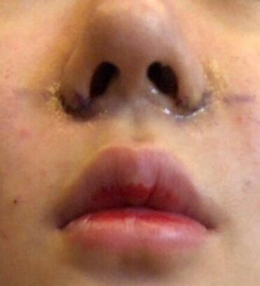 鼻翼縮小整形手術(shù)體驗(yàn)日記