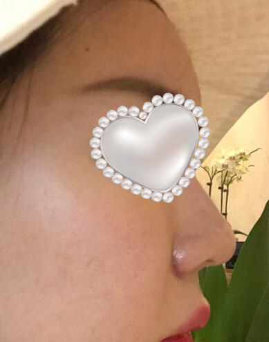 鼻翼縮小整形術(shù)后果圖對(duì)比