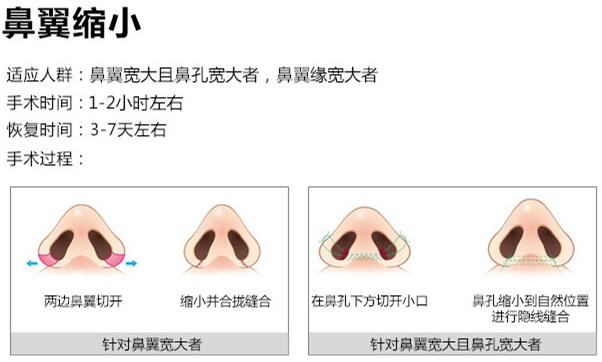 鼻翼縮小手術(shù)方法科普