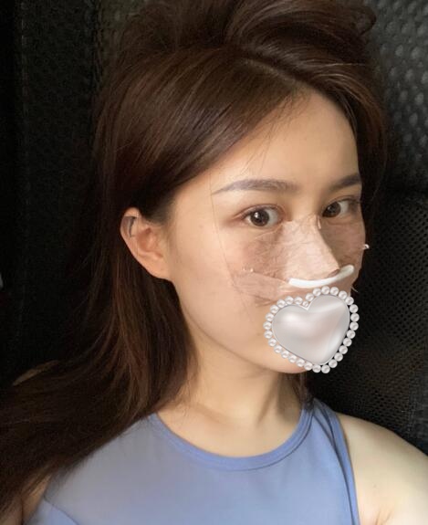 做隆鼻手術(shù)體驗(yàn)日記