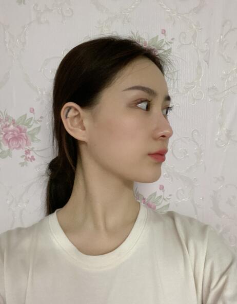 做隆鼻手術(shù)體驗(yàn)日記