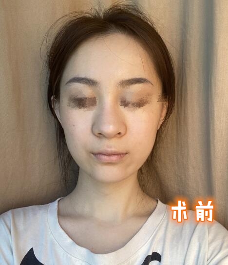 做隆鼻手術(shù)體驗(yàn)日記