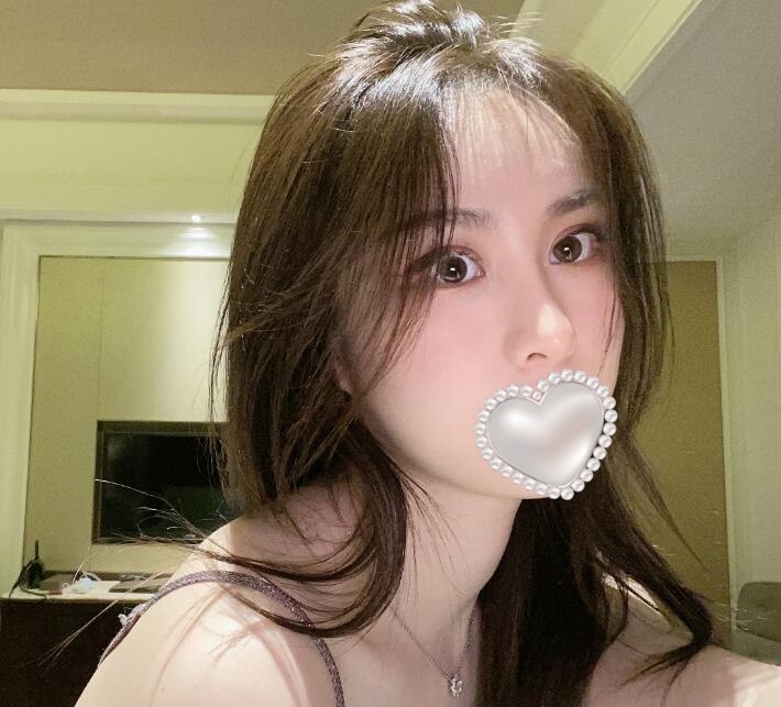 做隆鼻手術(shù)后果圖分享