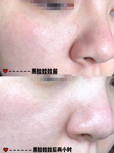 黑臉娃娃改良色素沈著果圖對比