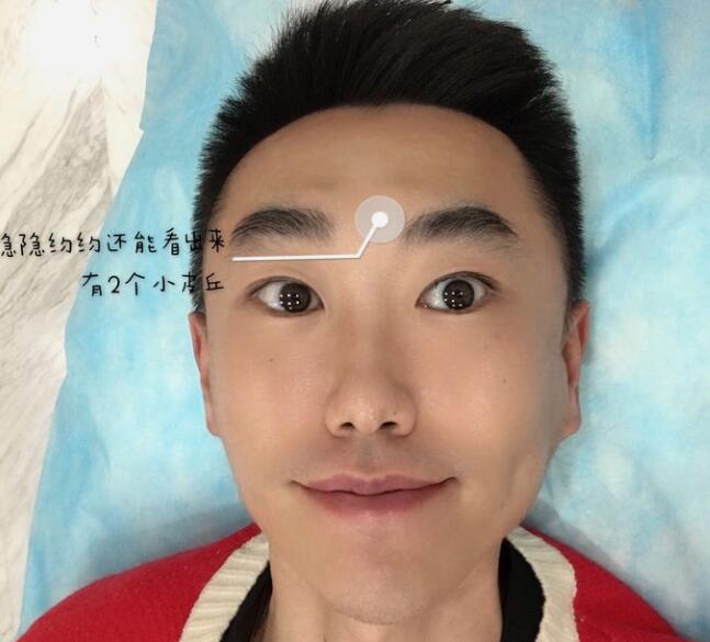 眉間注射除皺術(shù)后對比圖