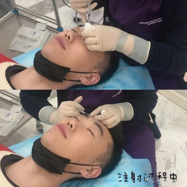 眉間注射除皺術(shù)后對比圖