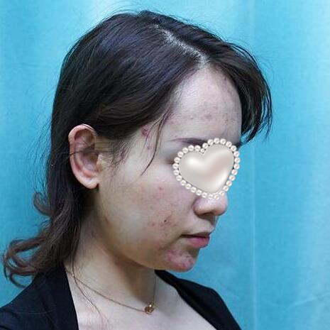 面頰吸脂果圖分享