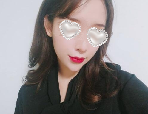 面頰吸脂果圖分享